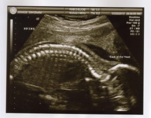 ultrasound spine